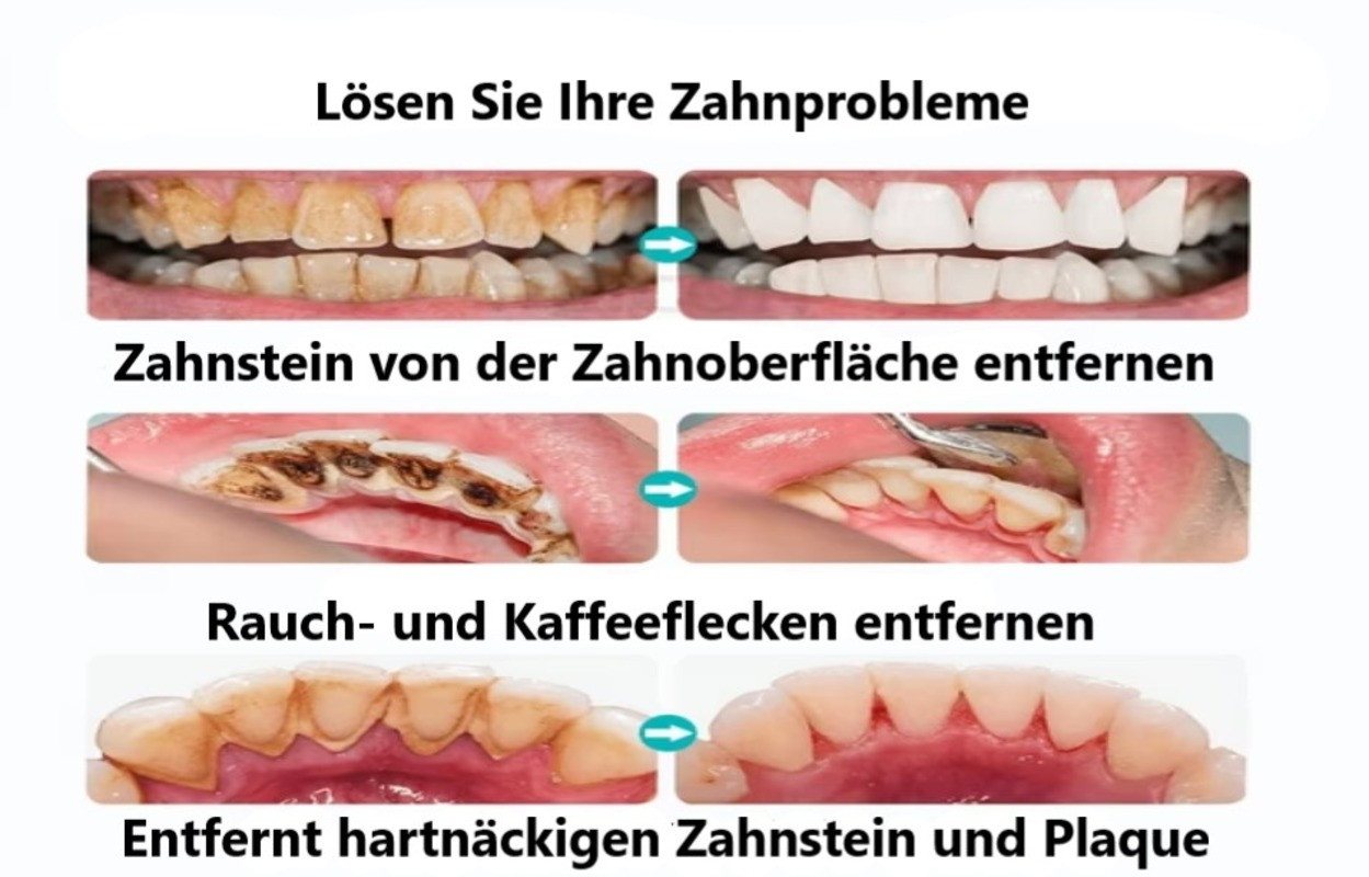 Montegoni Zahnpflege-Set Ultraschall Zahnsteinentferner,Zahnreiniger, Plaque-Fleckenentfernung, Haushaltszahnreiniger, Zahnsteinentferner exklusives Set mt 2 zusätzlichen Aufsätzen